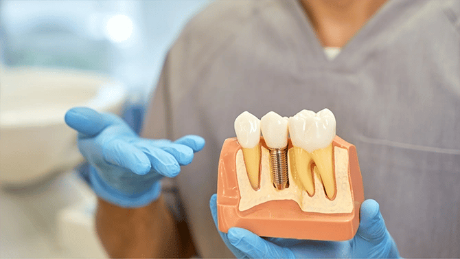 Close-up photo of Dentist’s hands wearing blue gloves presenting a sample dental implant.